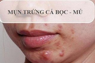 mun-trung-ca-boc.jpg